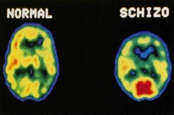 I'd rather suffer from leukemia than be a disorganized schizophrenic. At least I would be somewhat normal.  